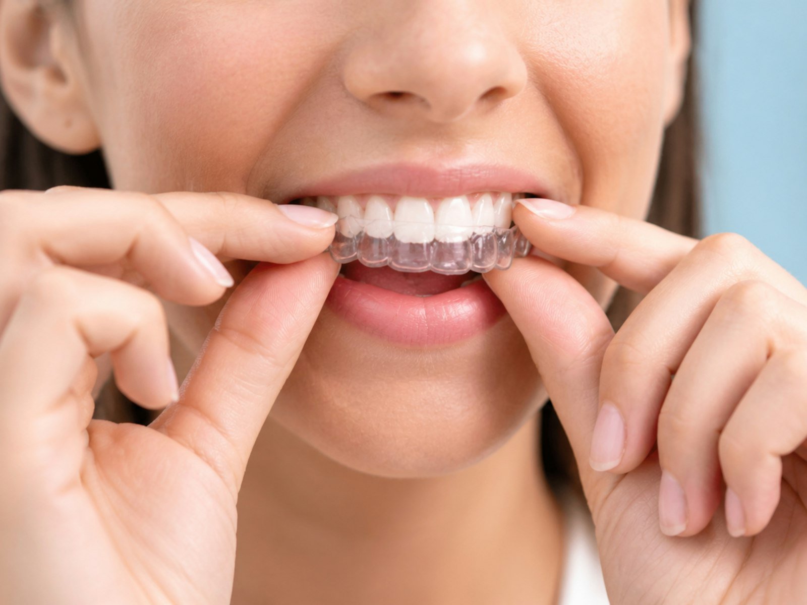 Colocacion de un alineador dental transparente
